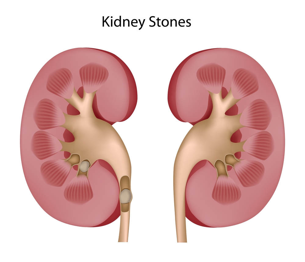 Blood Vessel Calcification in those with Kidney Stones at increased Heart Disease Risk
