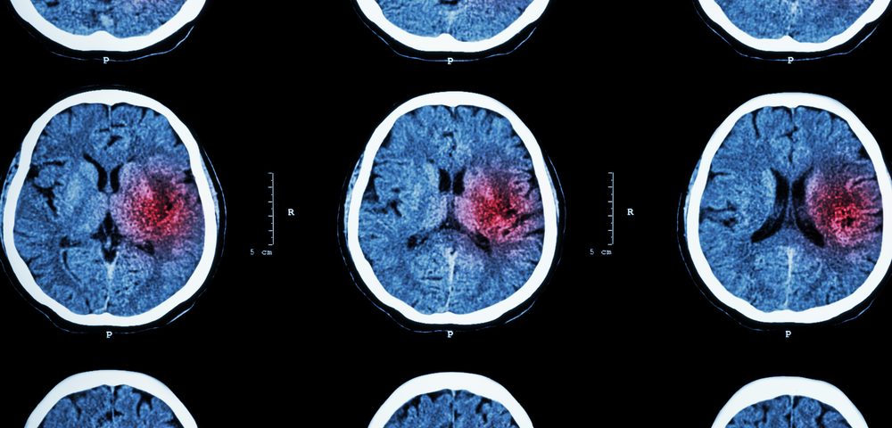 10 Major Risk Factors for Stroke Can Be Modified, Researchers Report