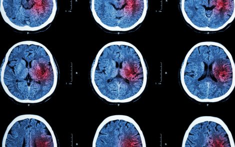 10 Major Risk Factors for Stroke Can Be Modified, Researchers Report
